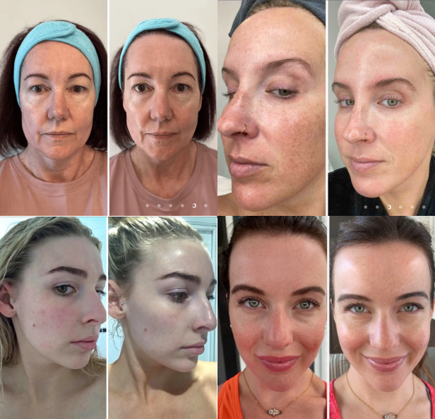 [COMPRE 1 LEVE 2] BiocollagenPlus - Máscara absorvível de colágeno + ativos do botox.